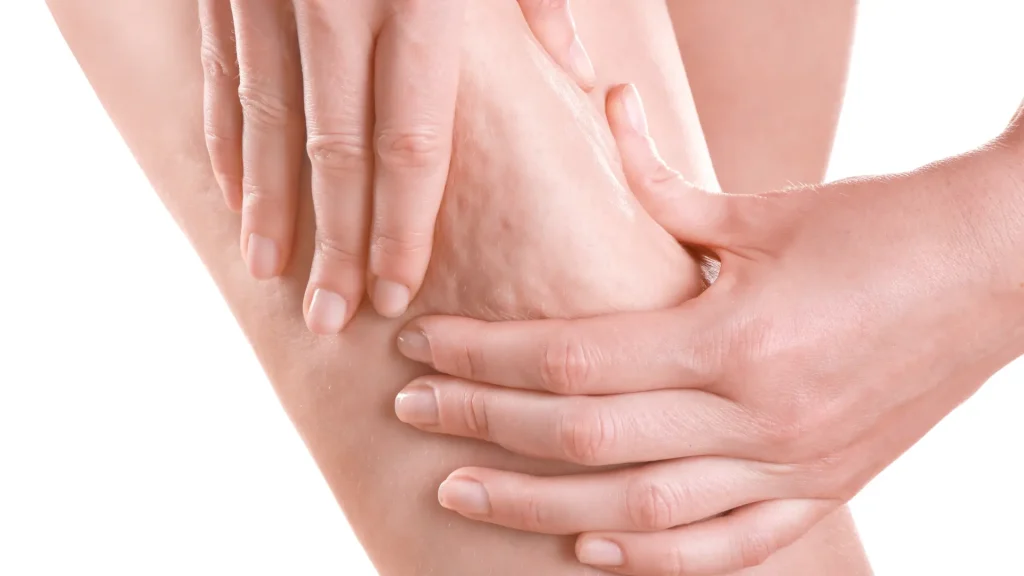 Common-Side-Effects-of-Alidya-for-Cellulite-Reduction-1024x576 (1)