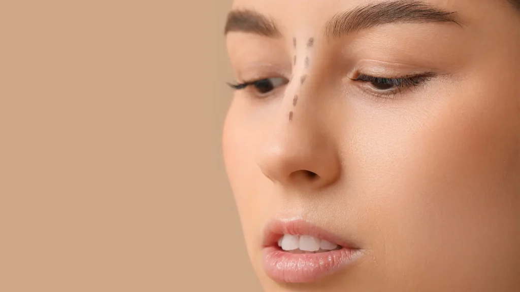 Areas-of-the-Nose-Treated-with-PDO-Threads-1024x576
