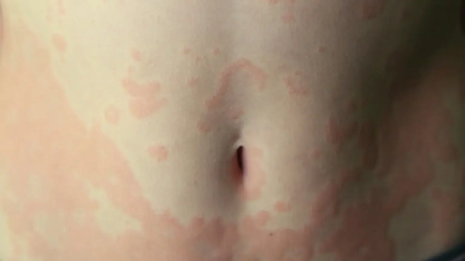Common-Side-Effects-of-Cimzia-1536x864