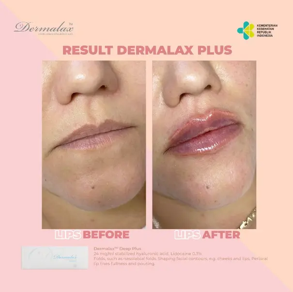 Dermalax-Before-and-After-1