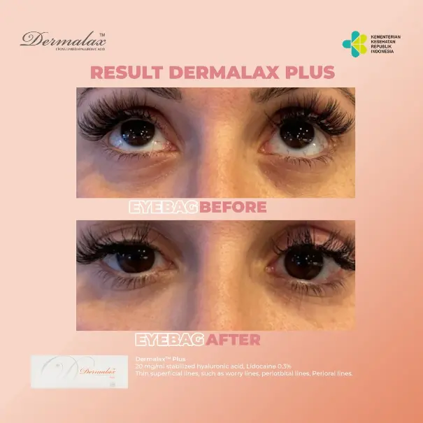 Dermalax-Before-and-After-2