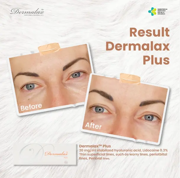 Dermalax-Before-and-After-3