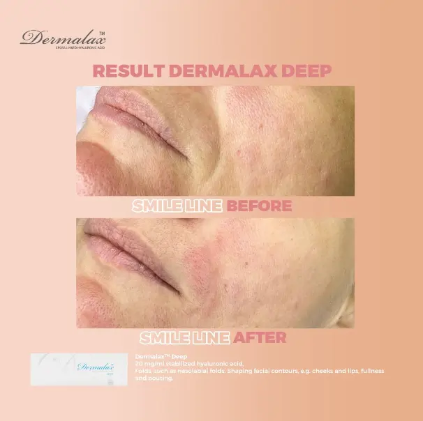Indications-and-Applications-of-Dermalax-Deep-Plus-1