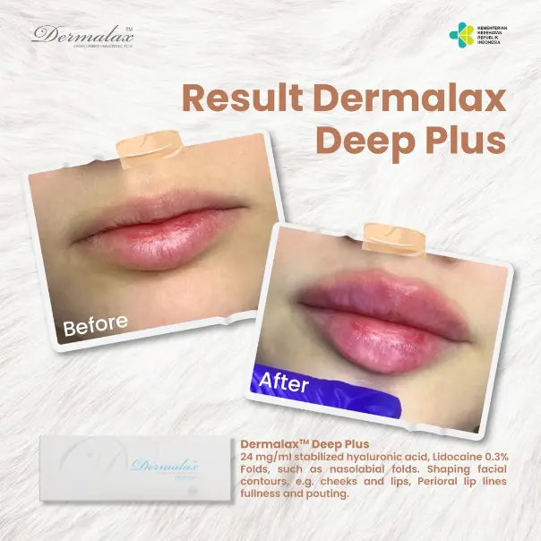 Indications-and-Applications-of-Dermalax-Deep-Plus-2