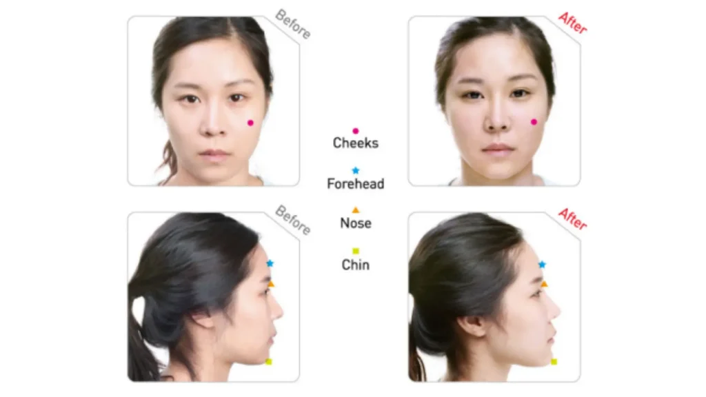Indications-and-Applications-of-Dermalax-Deep-Plus-3-1024x576